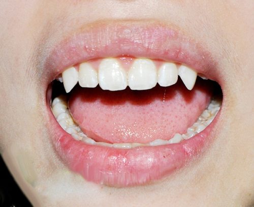 3 cách làm cho răng nanh dài ra tại nhà đơn giản và hiệu quả - Mẹo Sức Khoẻ