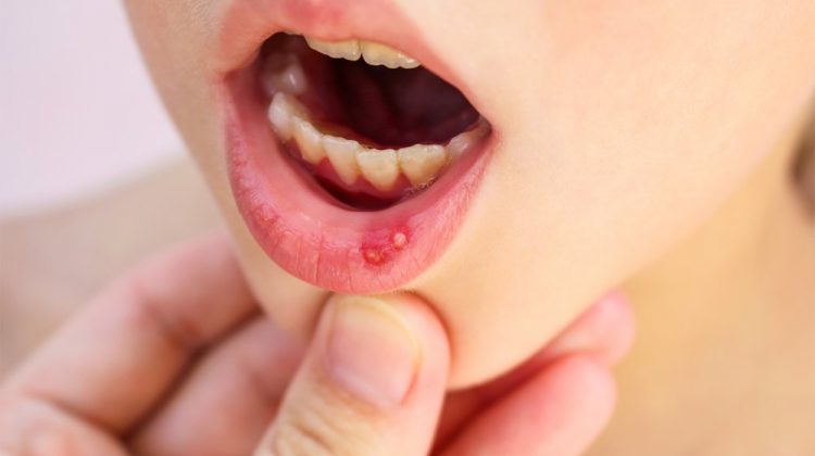 Trẻ bị nhiệt miệng và sốt: Nguyên nhân và Cách điều trị là gì