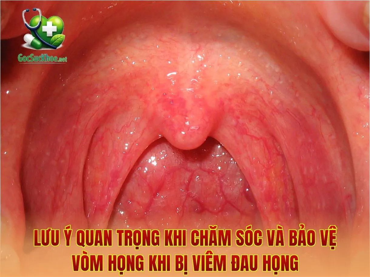 Lưu ý quan trọng khi chăm sóc và bảo vệ vòm họng khi bị viêm đau họng
